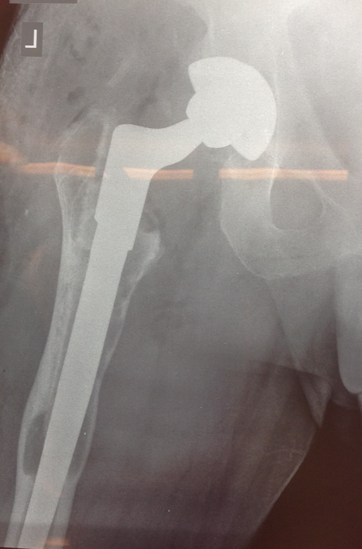 Hip Prostheses:  Total, Revision:  ZMR (Implant 1407075)